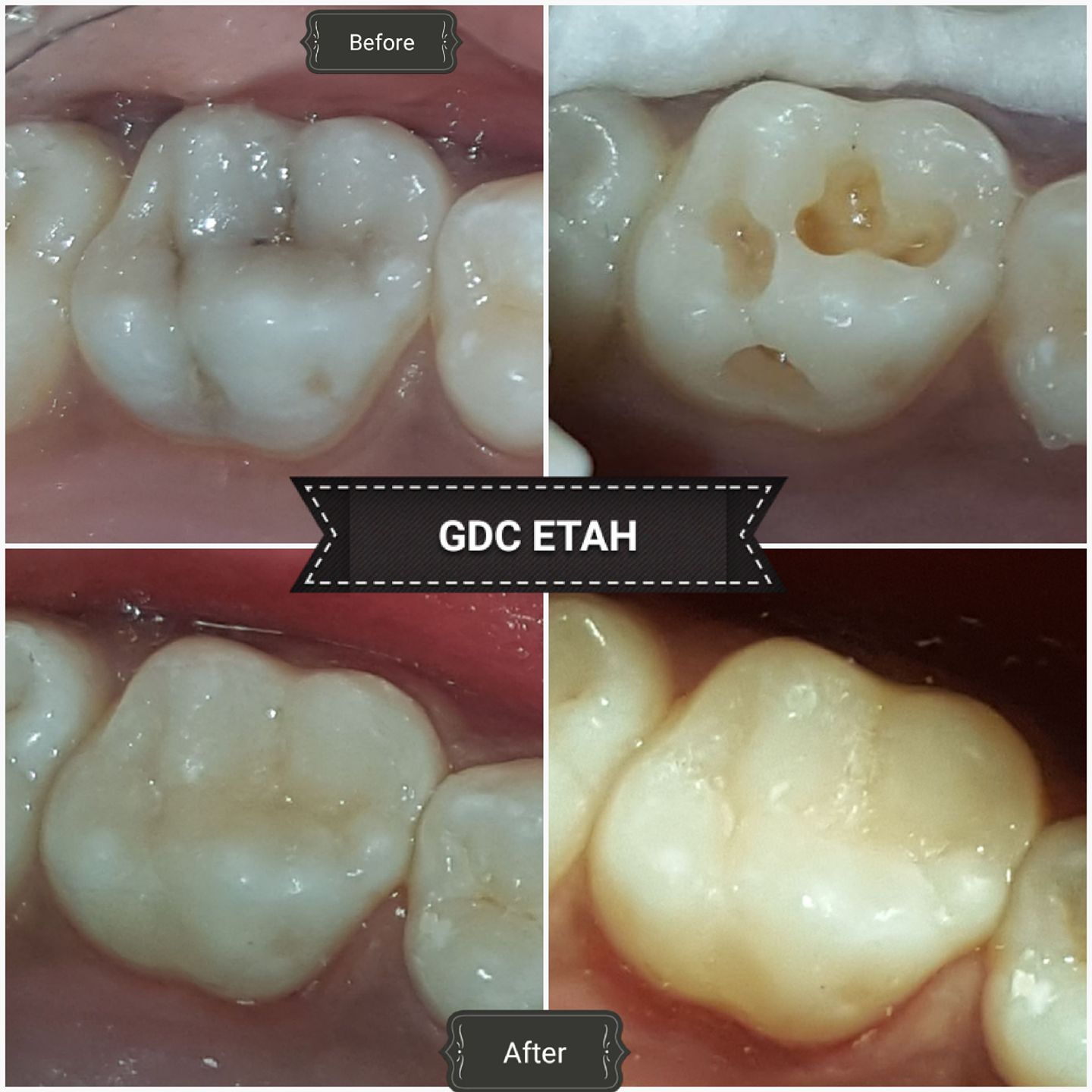 Dental composite